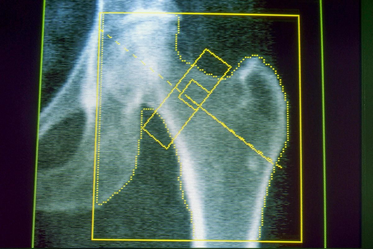 glp 1 arthritis Natural GLP-1 Discovery Hidden in Joints Could Revolutionize Treatment New research suggests that prolonged