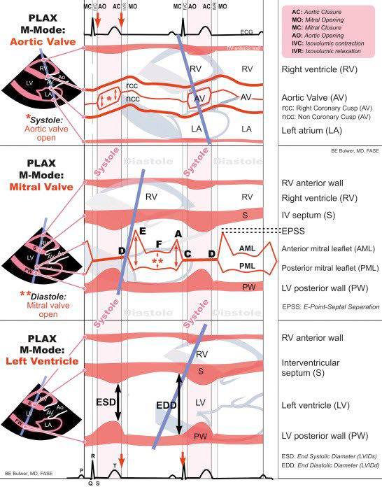 Cardiophilia - M-Mode Echocardiography Explained This figure ...