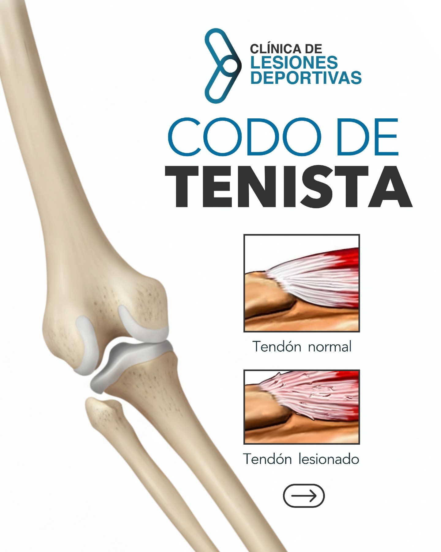🎾 EPICONDILITIS o “Codo... - Clínica de Lesiones Deportivas | Facebook