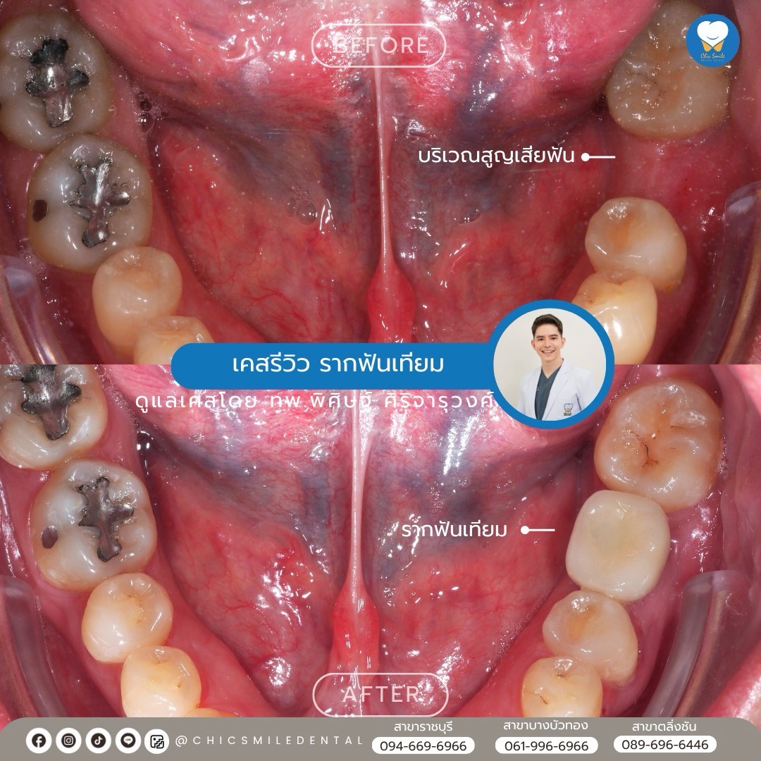 Chic - เพิ่มความมั่นใจในรอยยิ้มด้วยรากฟันเทียม🫶🏻 👉ไม่ต้องกังวลเรื่องการ ...
