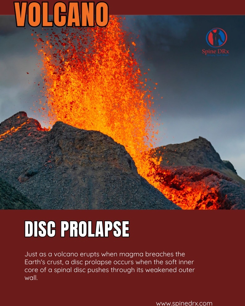 Spine DRx - How is a disc prolapse similar to a volcanic... | Facebook