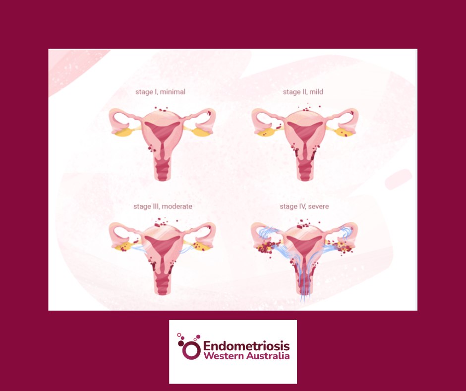Endometriosis - 💛 The Stages of Endometriosis — What They Really Mean ...