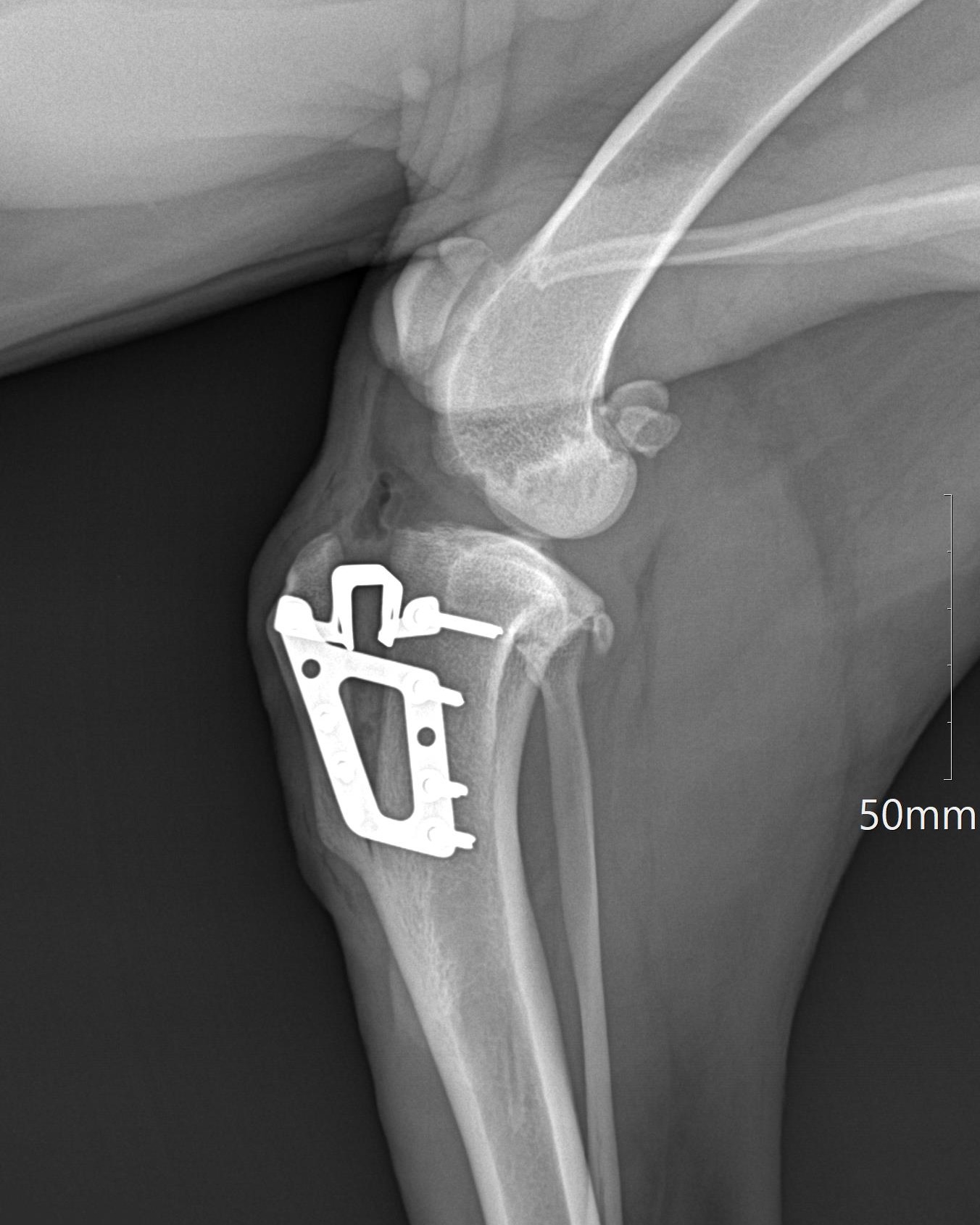 Radiografia Da Tuberosidade Tibial Fractura Avulsión De La