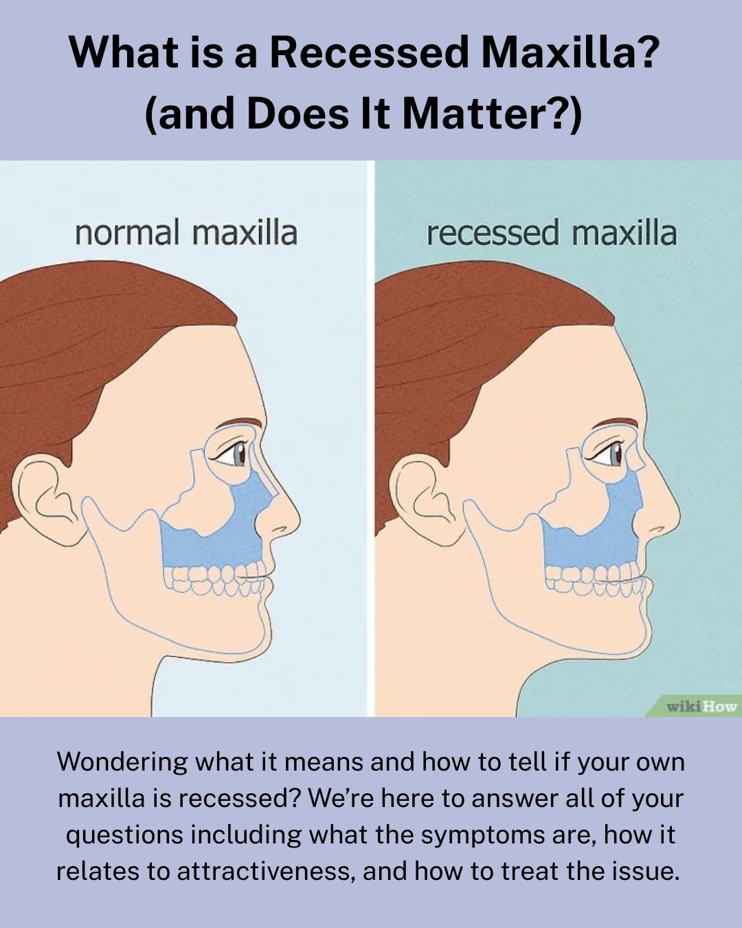 wikiHow - If you’ve seen “recessed maxilla” posts on... | Facebook