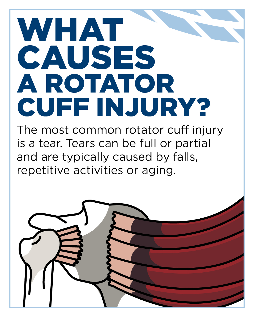 Sanford Health - A rotator cuff tear is a common cause of... | Facebook