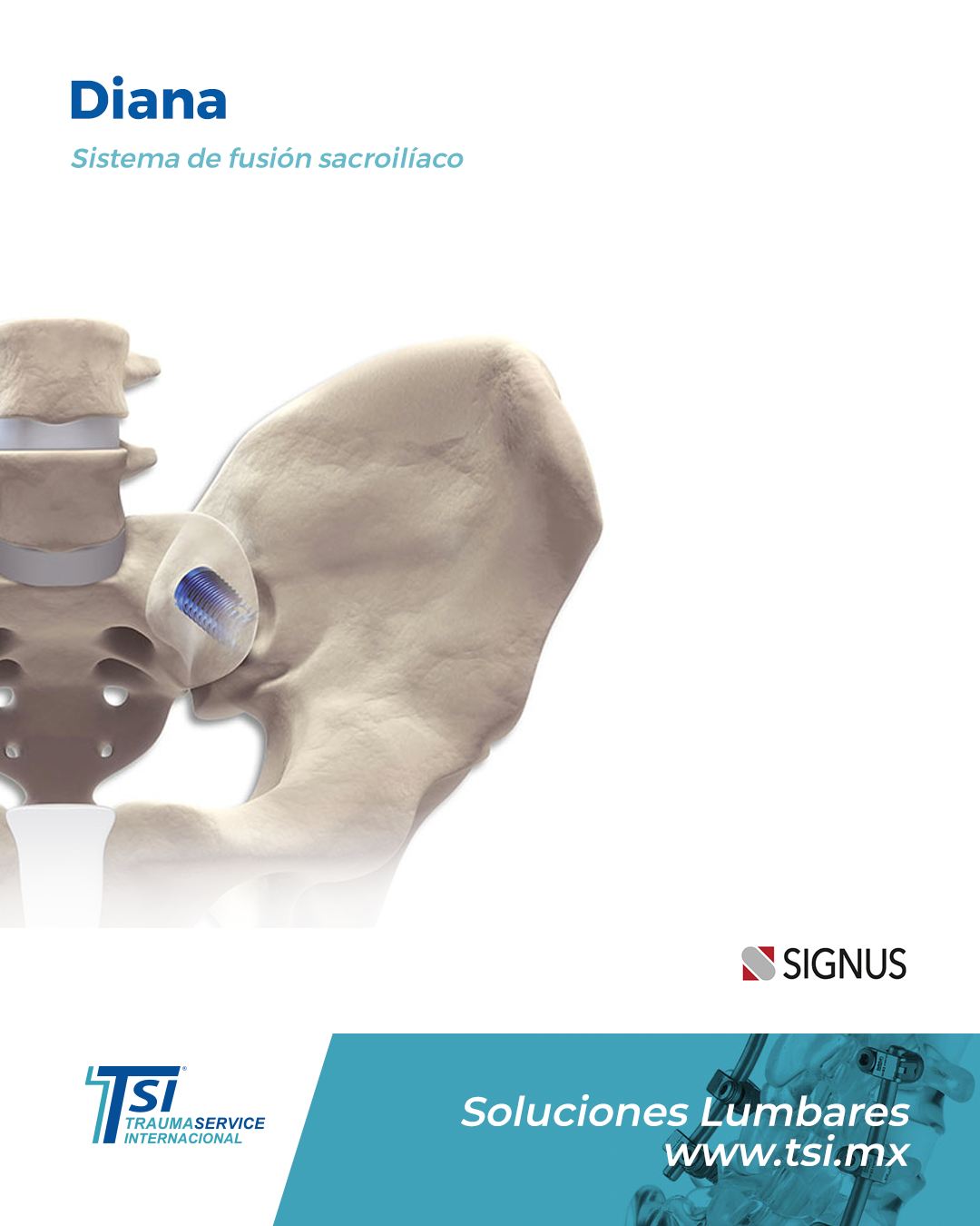 Traumaservice - El implante DIANA, mediante instrumental avanzado y una ...