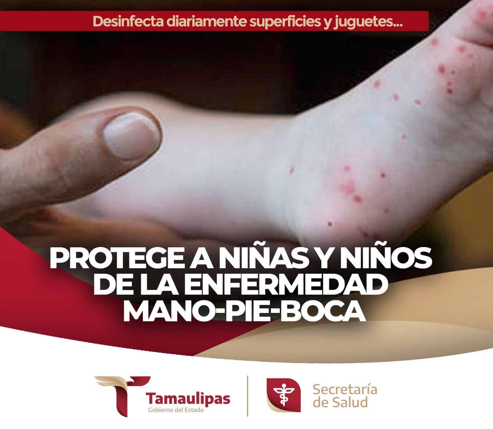 secretar-a-protege-a-ni-as-y-ni-os-de-la-enfermedad-mano-pie-boca