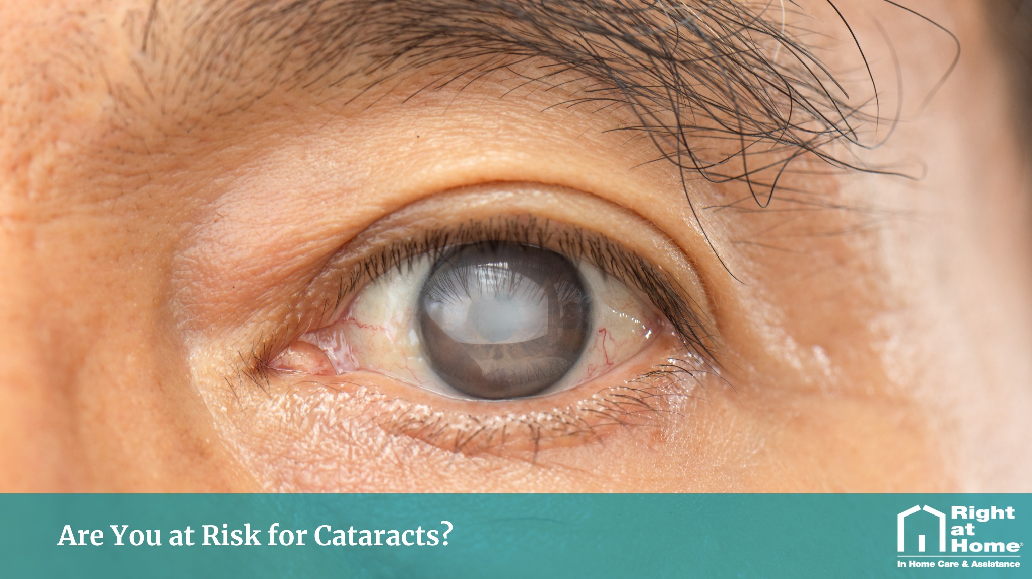 Blurry vision, trouble driving at night, or colours looking duller than usual? Cataracts are one of the most common age-related conditions and often develop gradually over time, making the changes easy to