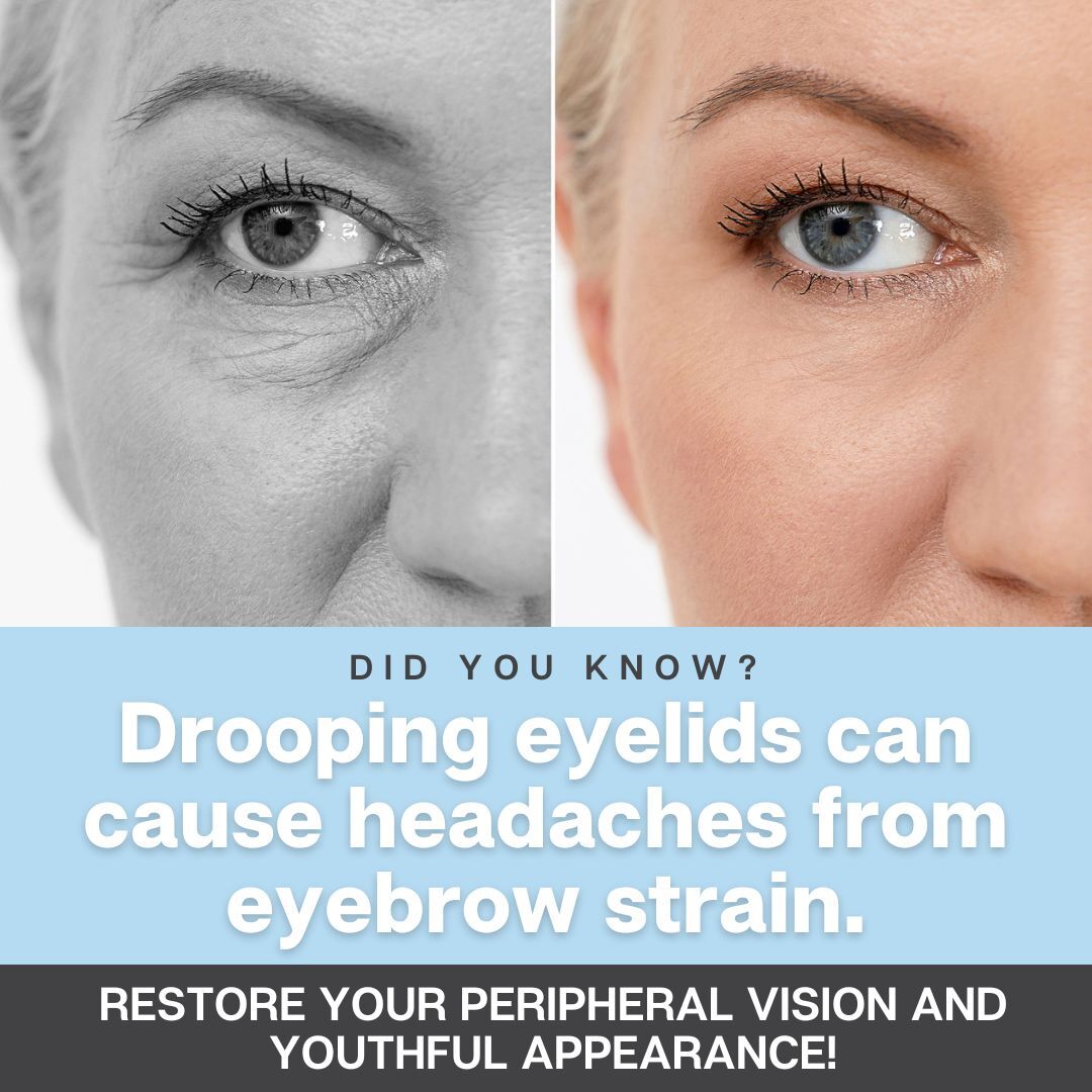 Northwest - Drooping eyelids aren't just a cosmetic concern—they can ...