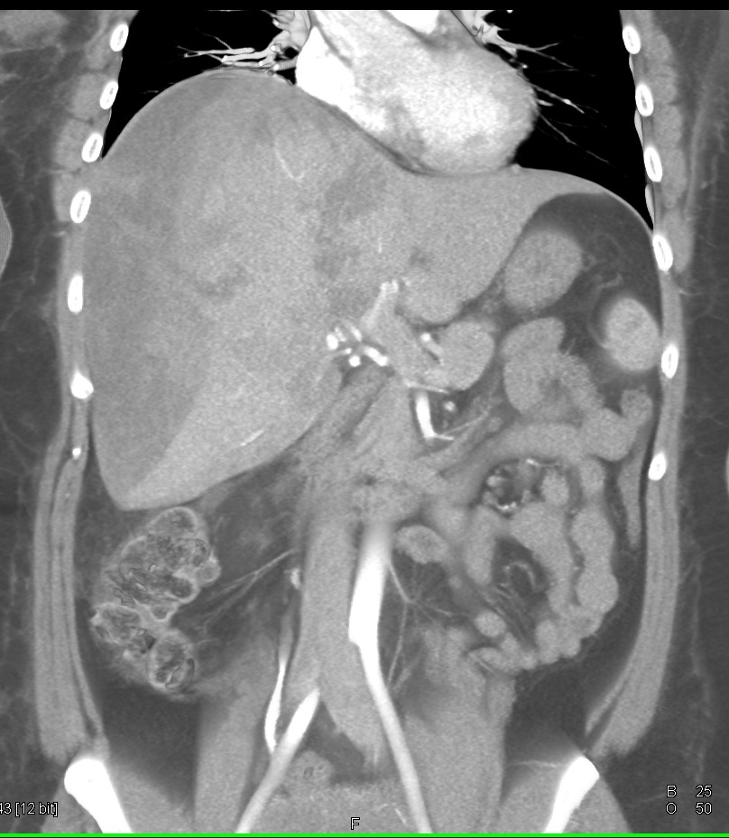 CTisus: Cutting edge information on body CT (Computed tomography ...