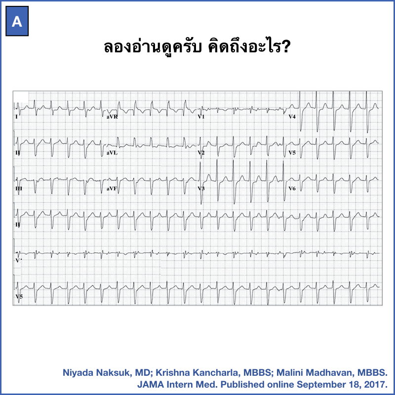 ecg-qrs-pmk-cardiology-review-facebook