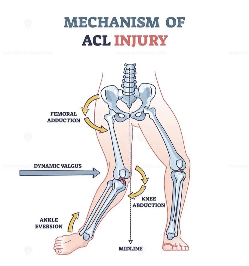 CHEAR SI - กลไกการบาดเจ็บของเอ็นไขว้หน้า (ACL Injury... | Facebook