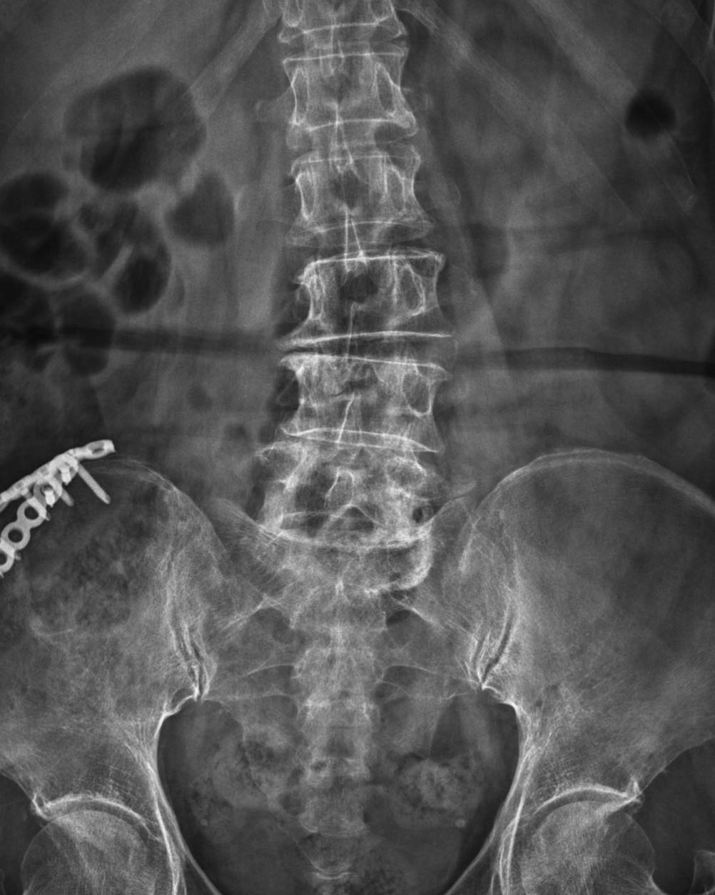 黃立人 - DePuySynthes,Johnson & Johnson MatrixRib plating system 在過去這10年時間 ...
