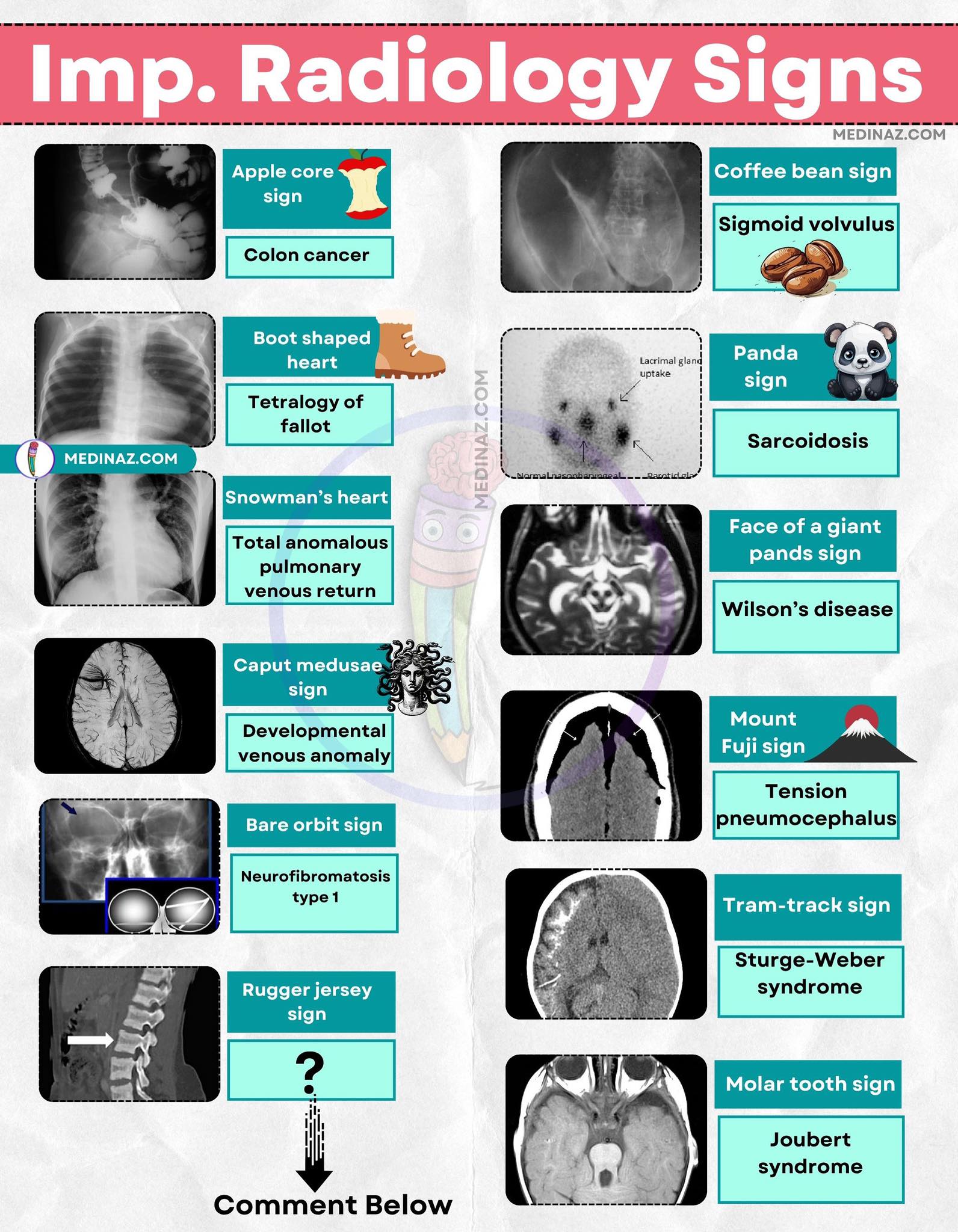 Medinaz - Important radiographic signs ⬇️ | Facebook
