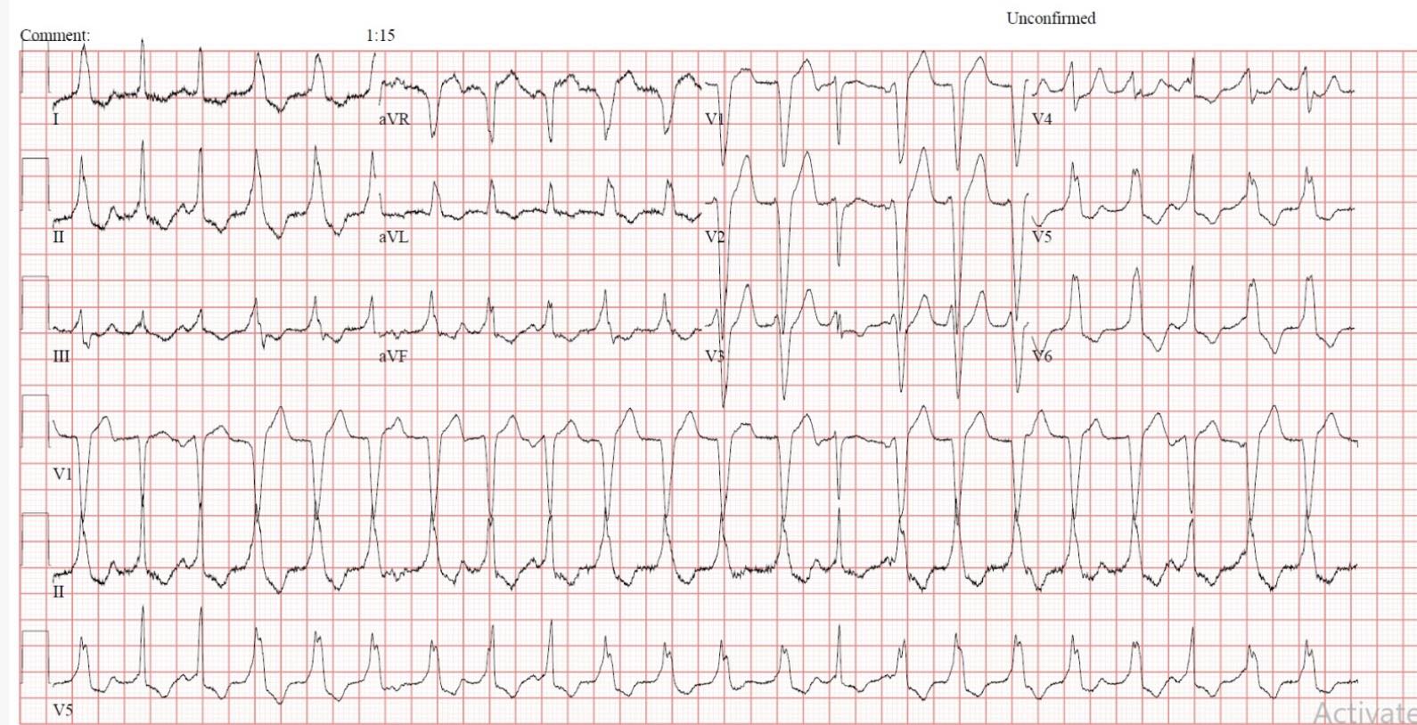 EMS 12-Lead - Another great case from ECG aficionado... | Facebook