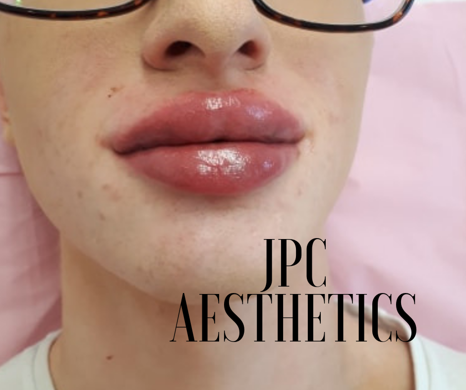 JPC Aesthetics - *** JPC Aesthetics - NEW LIP TECHNIQUE ONLY £169 ...