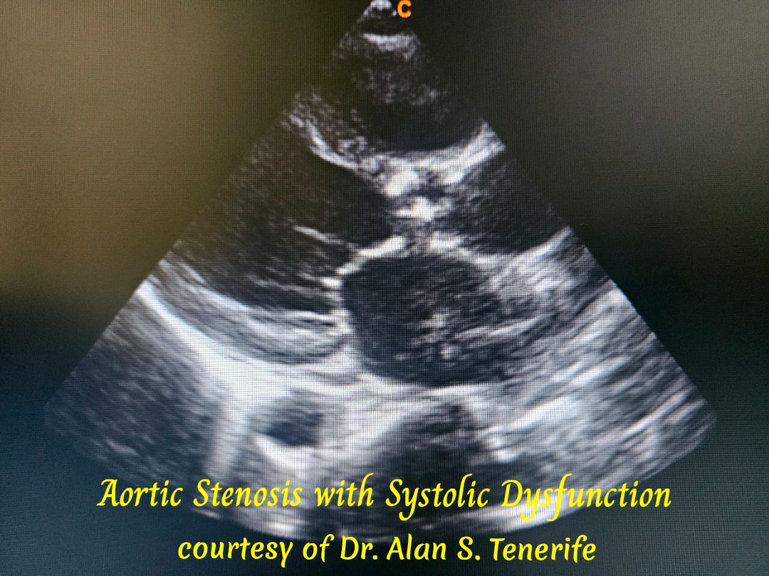 Dr. - AORTIC VALVE STENOSIS AND SYSTOLIC DYSFUNCTION In aortic valve ...