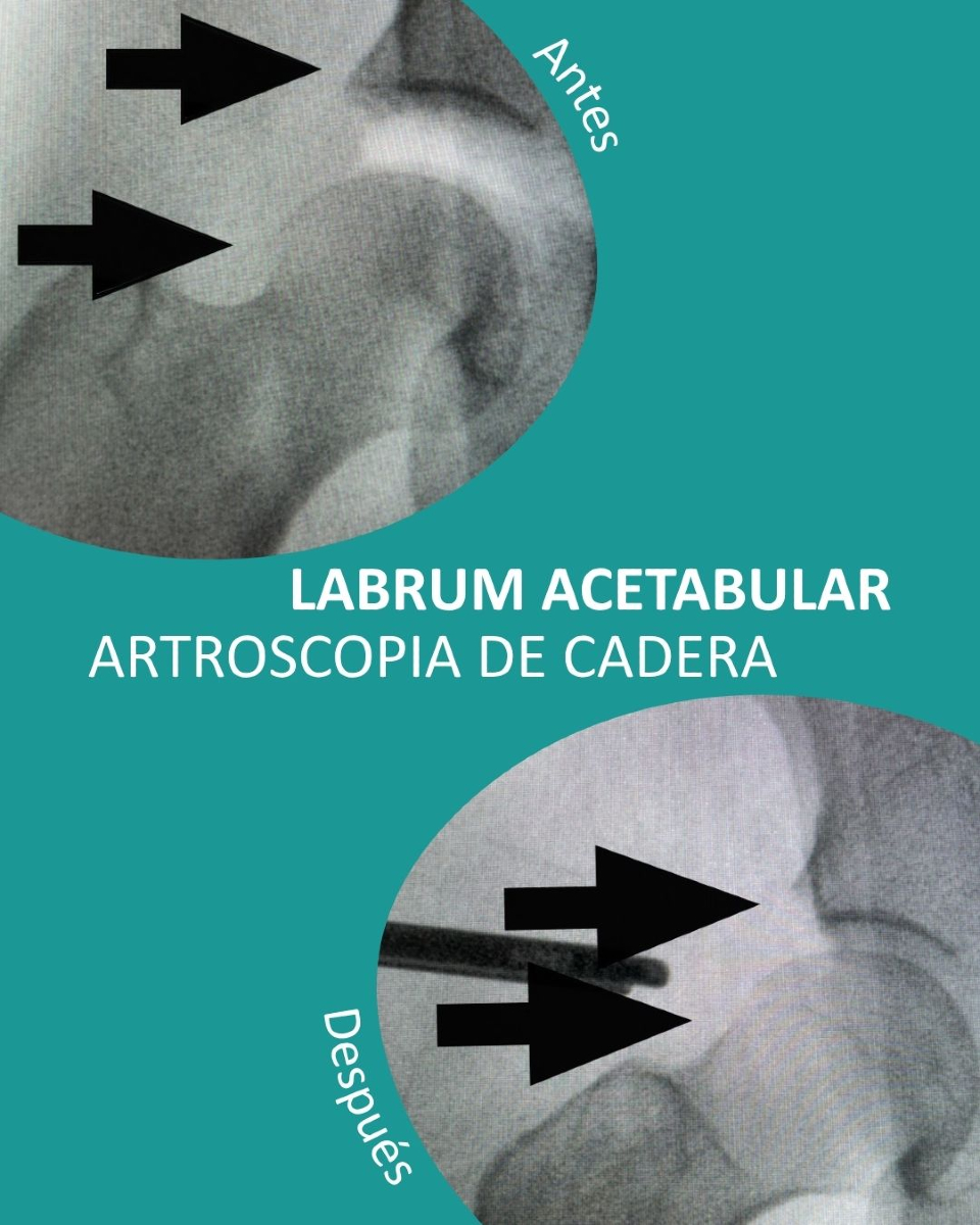 Instituto - 🦴 ¿Dolor en la cadera? Podría ser el labrum acetabular ...