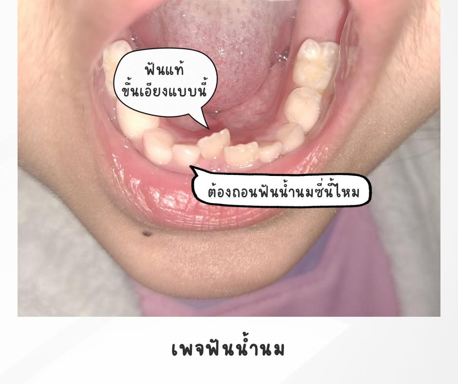 ฟันน้ำนม - พี่พิม น้องพะเพื่อน น้องพะแพง 3 สาวพี่น้องที่น่ารัก มาทำฟัน ...