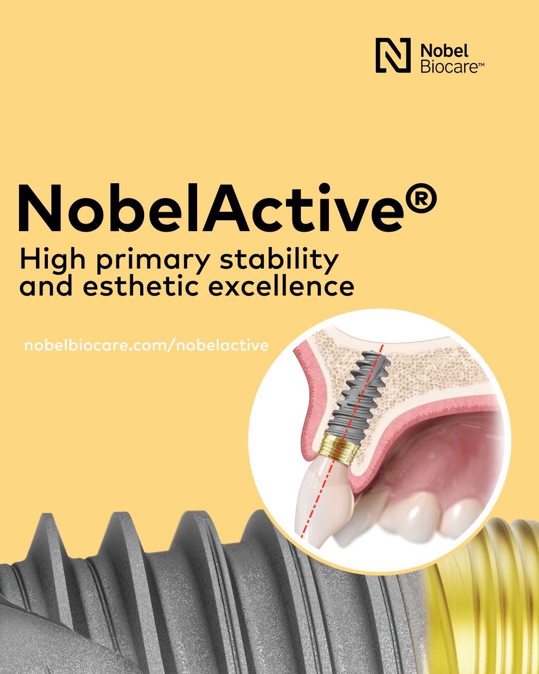 Nobel Biocare - NobelActive®, an implant like no other.... | Facebook