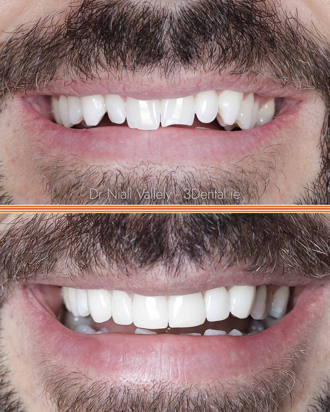 3Dental - Subtle, Natural Smile Upgrade This patient wanted to: ️ Fix ...
