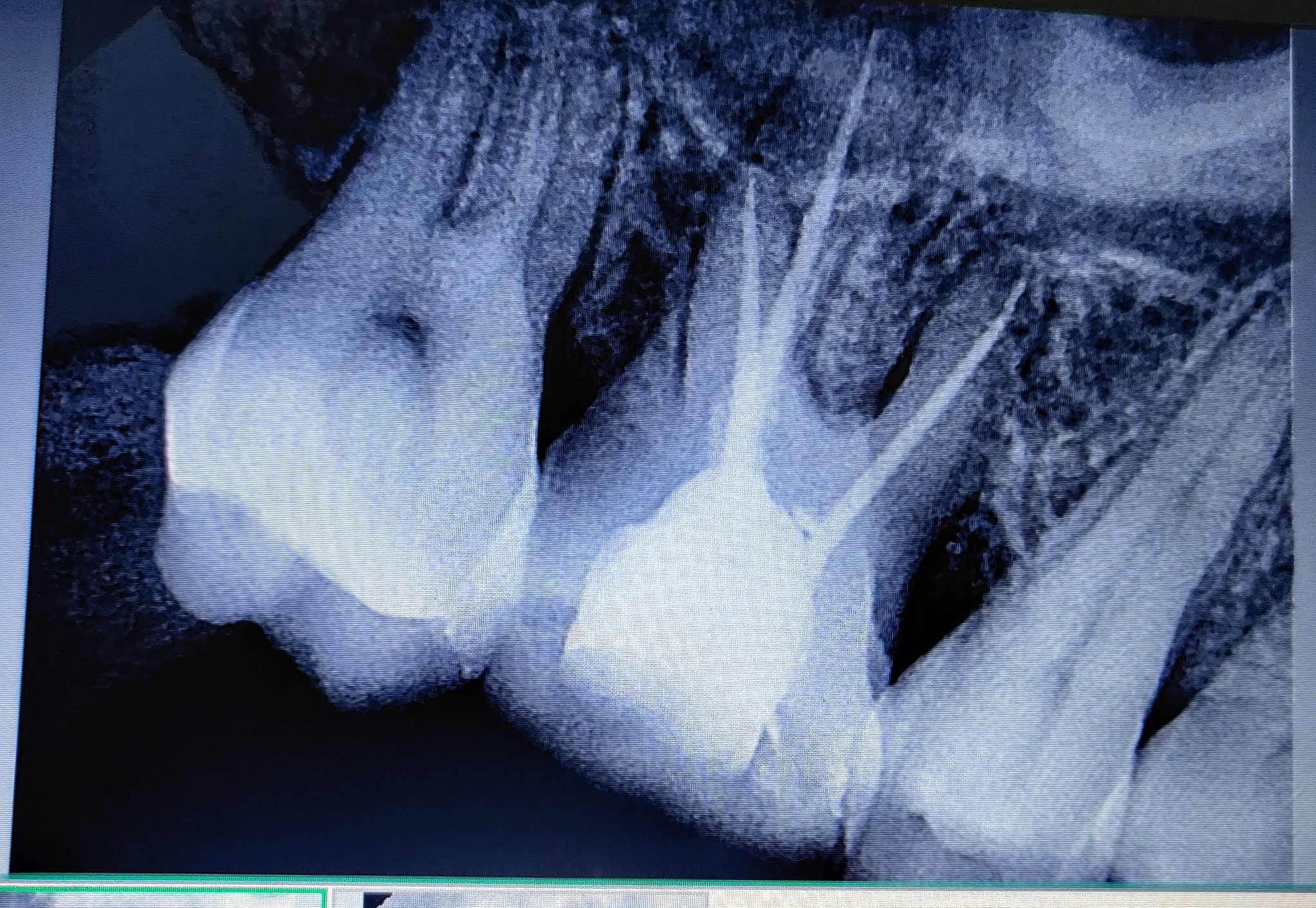 Rct on 16 Case of periapical... - Tooth Care Centre | Facebook