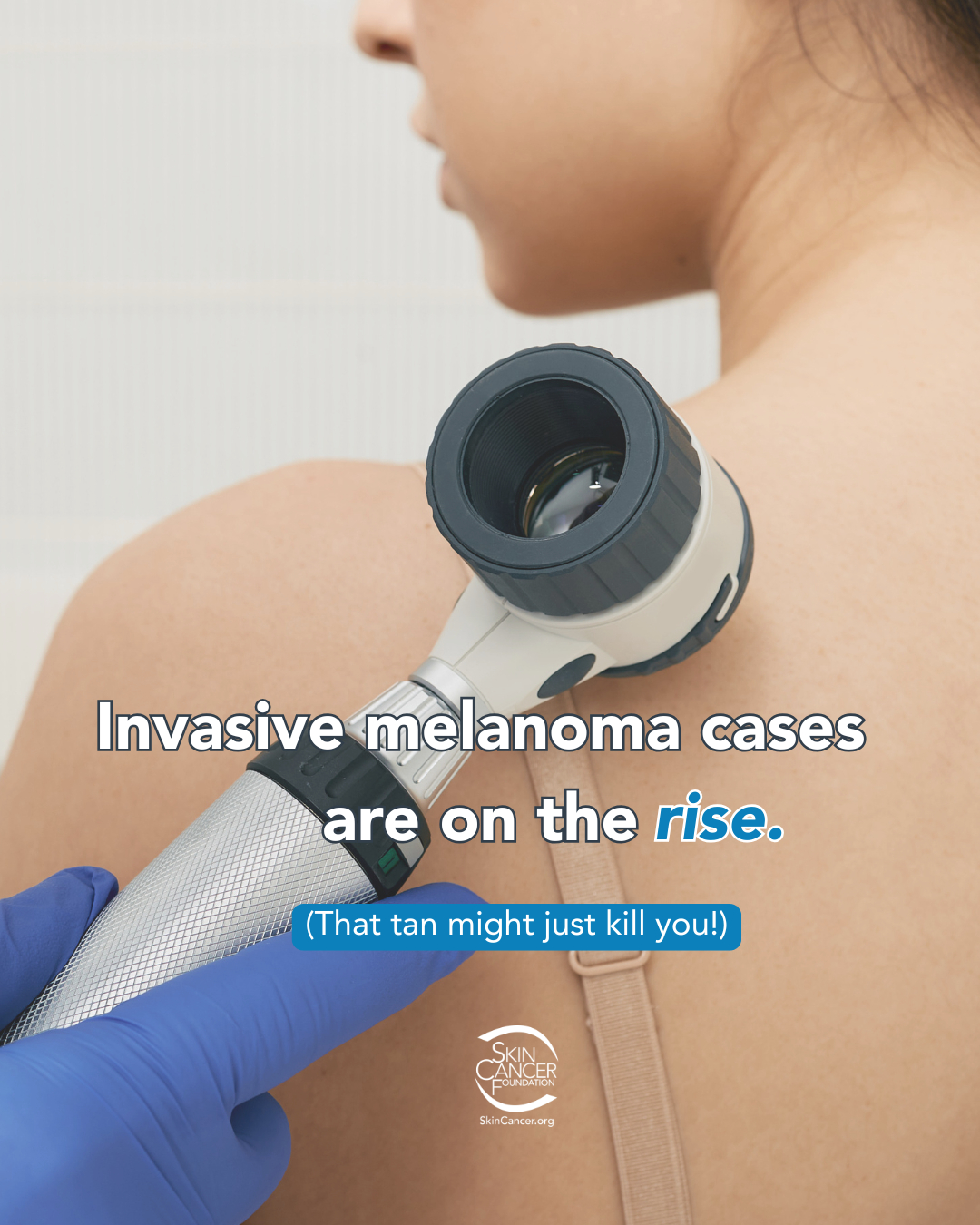 The Skin - It's 2026: melanoma is increasing and tanning is trending ...