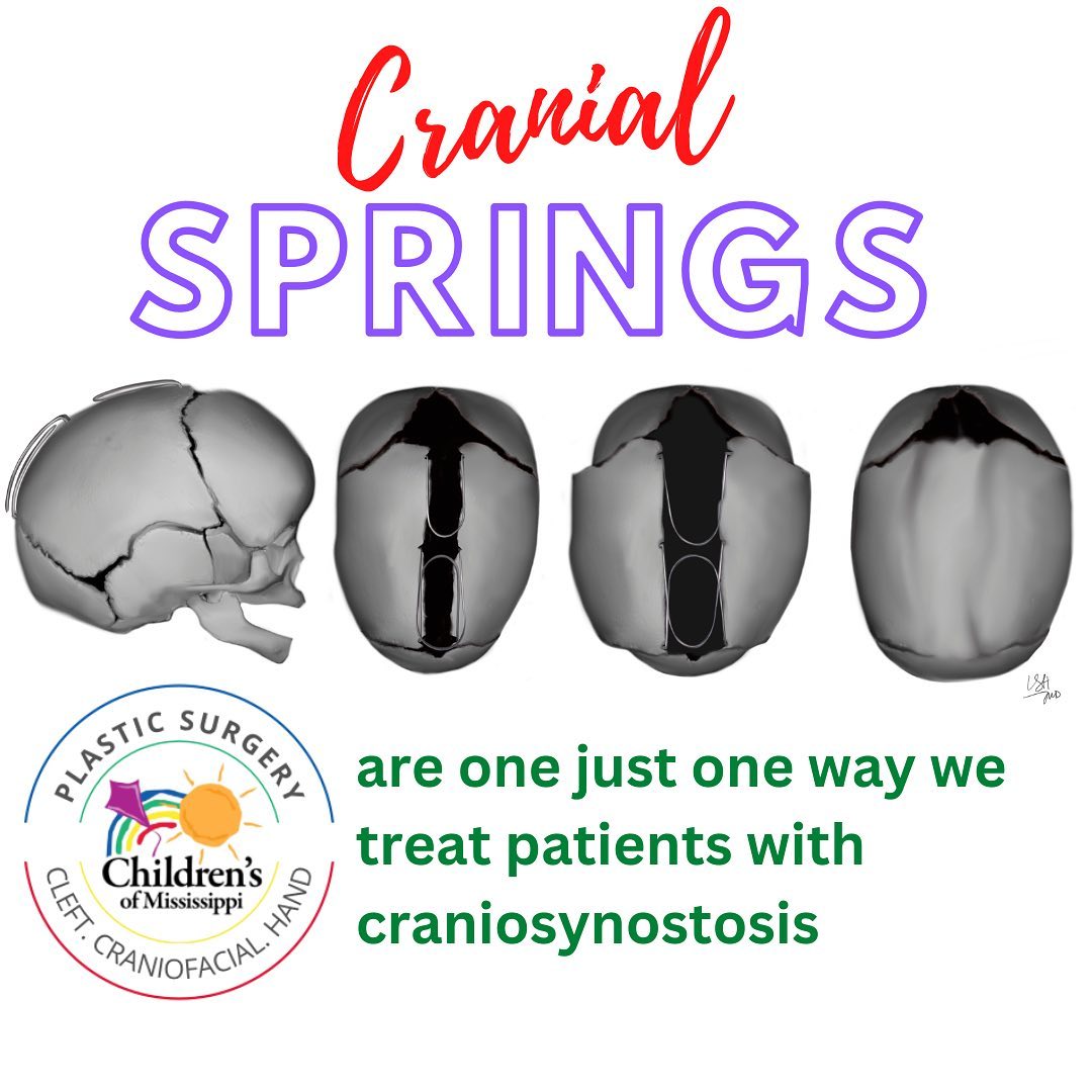 Strip craniectomy and cranial expansion with springs is a minimally ...