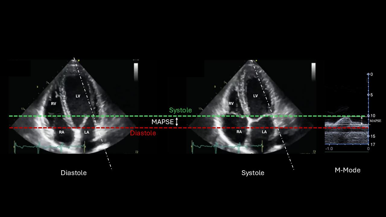 Cardiophilia - 🚨Mitral Annular Plane Systolic Excursion (MAPSE)🚨 🔴 ...