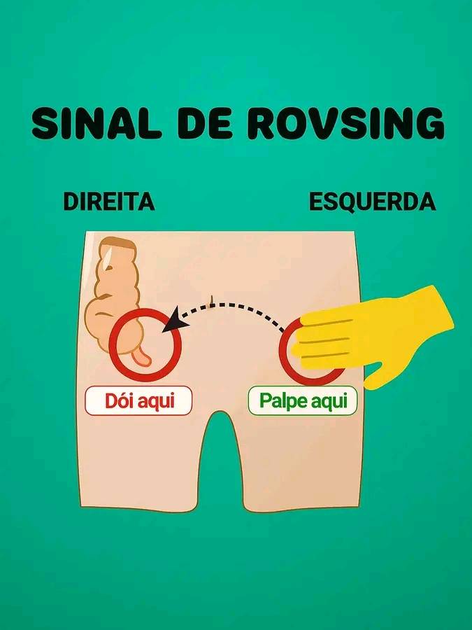 Nós Da Saúde - 🔎 SINAL DE ROVSING — O que é e por que... | Facebook