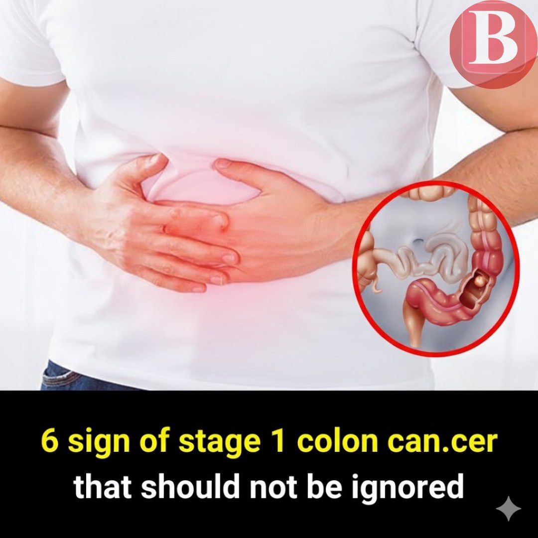 BNews - Colon can.cer, also known as colorectal can.cer, is one of the ...