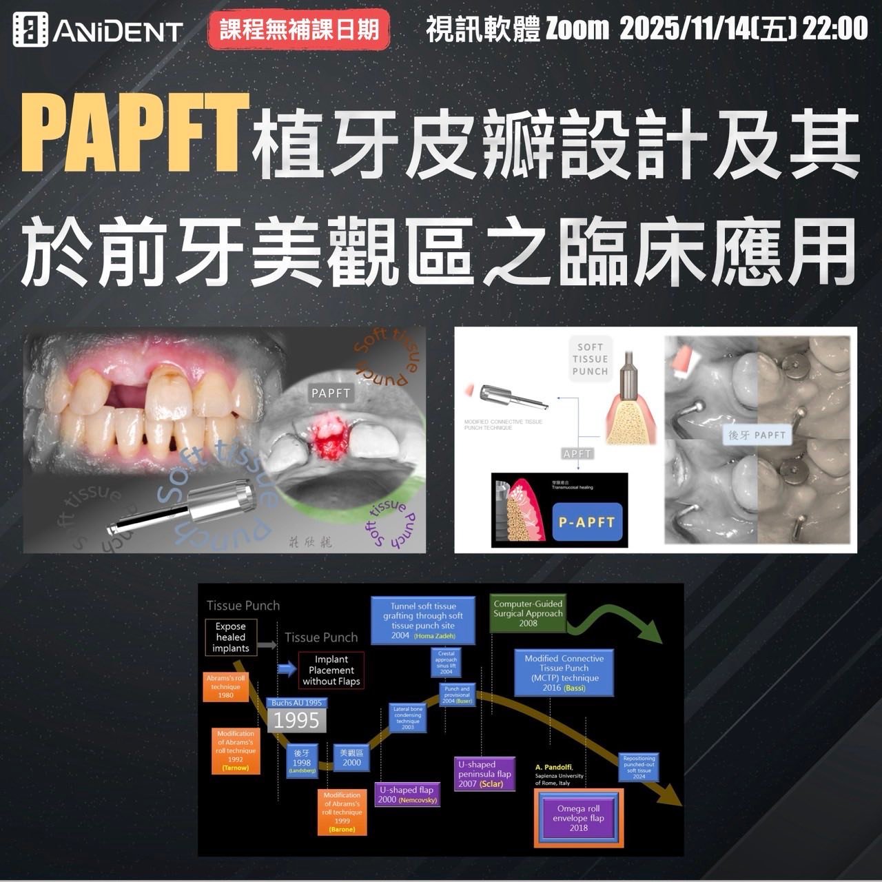 安立登 - 莊醫師開課啦 這次帶來超實用的【PAPFT植牙皮瓣設計】課程 從前牙美觀區到乳頭增生、軟組織移位技巧一次掌握！ 【學習重點】 1 ...