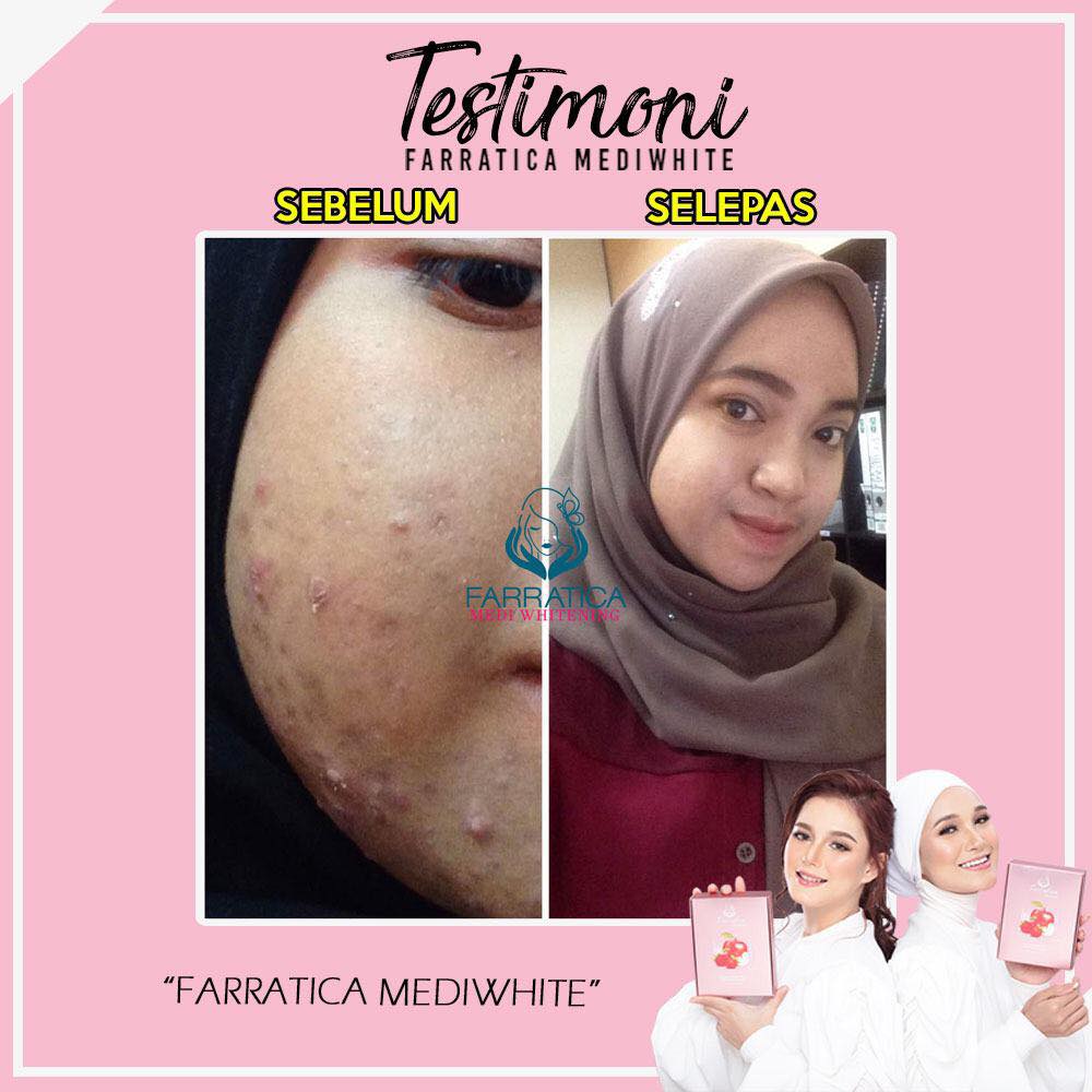 Beauty Tips How To Remove Pimples Farratica Beauty Hq Facebook