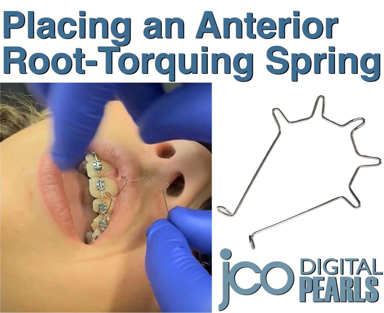 JCO - Does your patient need torque in the anterior region? Did you ...