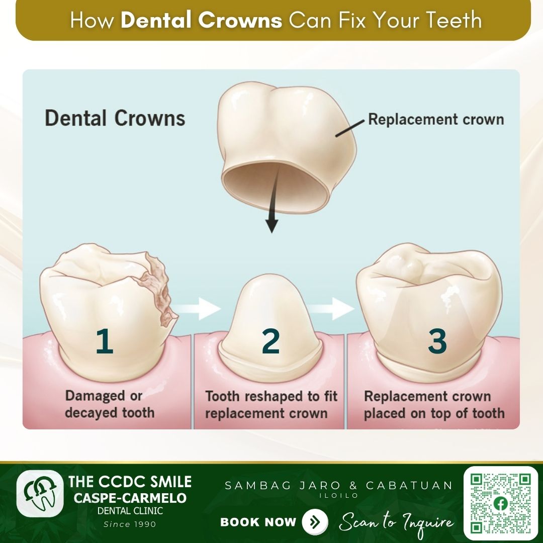 Caspe-Carmelo - May sira o chipped na ba ang ngipin mo? Dental crowns ...