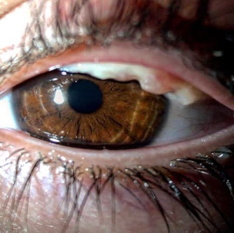 Ophthalmology-Notes - Ligneous conjunctivitis: Ligneous conjunctivitis ...