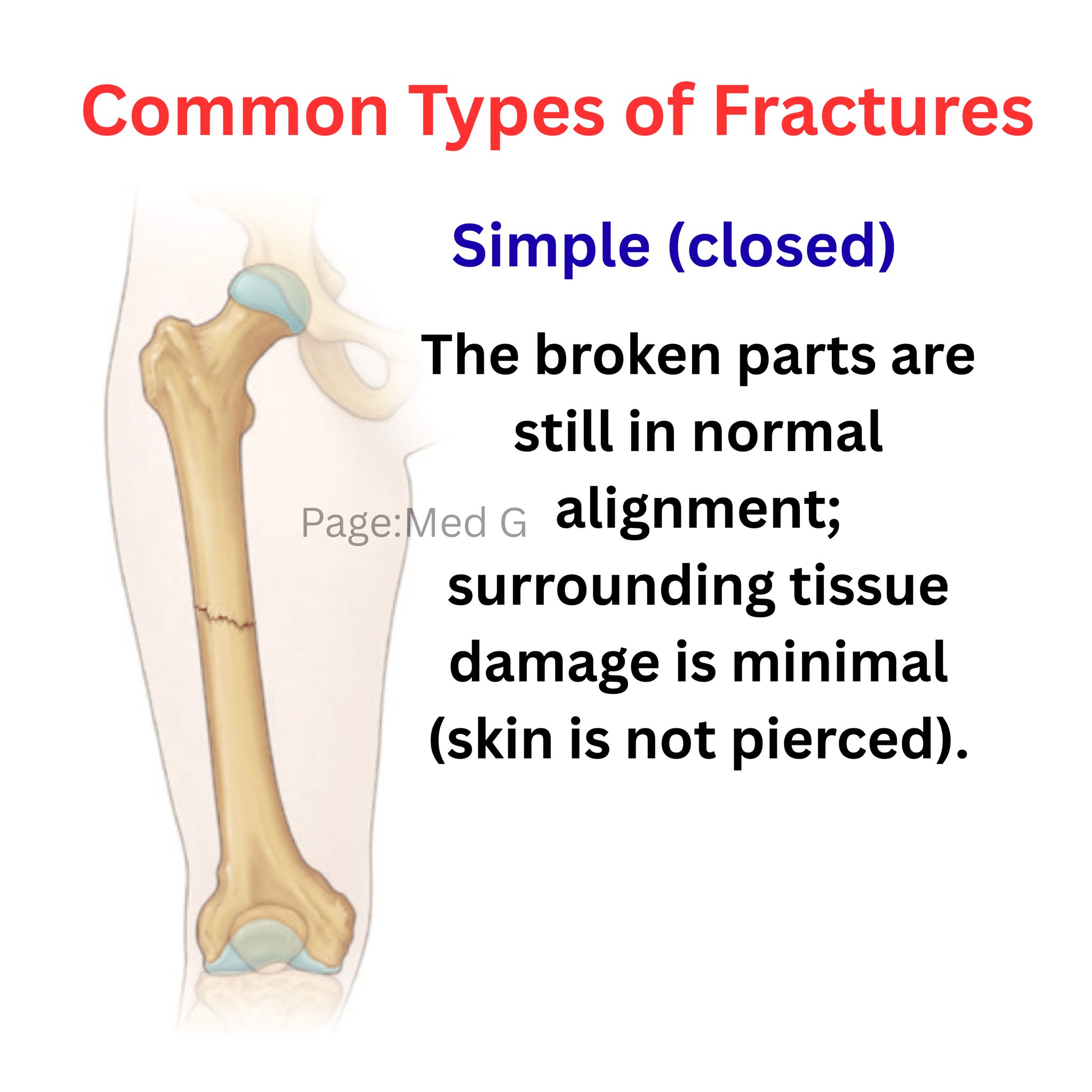 Med G - Common Types of Fractures #Orthopedics #education... | Facebook