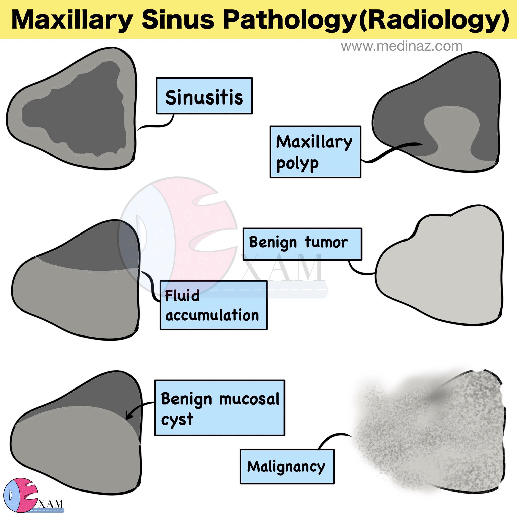 Dental Exam - Maxillary sinus pathology radiology | Facebook