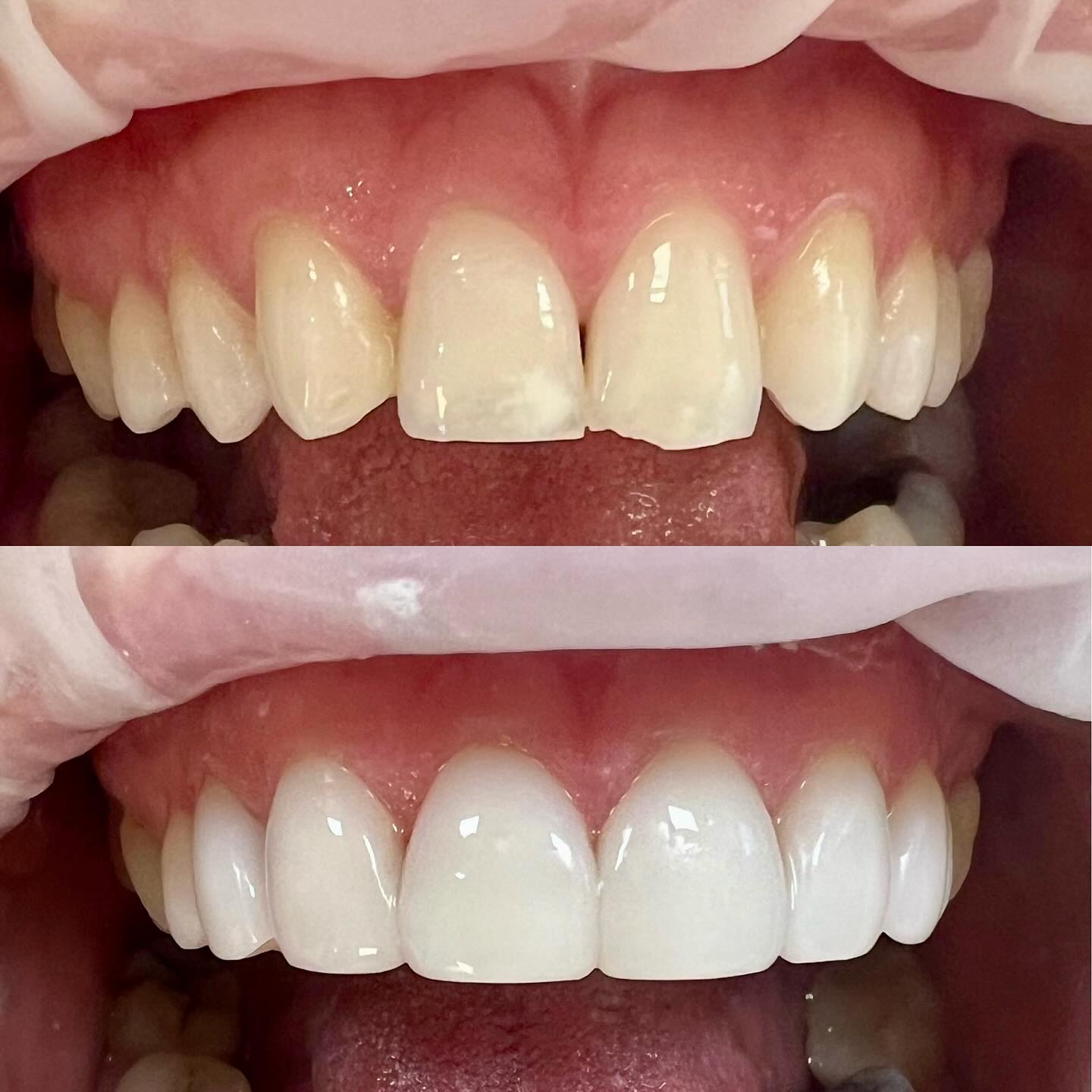 Dr - Did you know that composite bonding has been used by dentists for ...