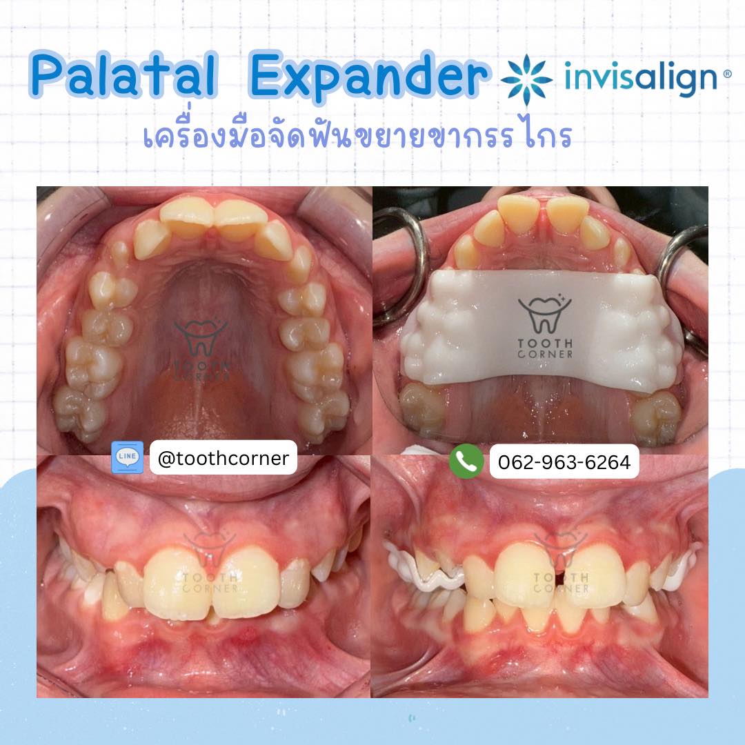 Tooth Corner Clinic - ทูธคอร์เนอะ สหคลินิก | Lam Luk Ka