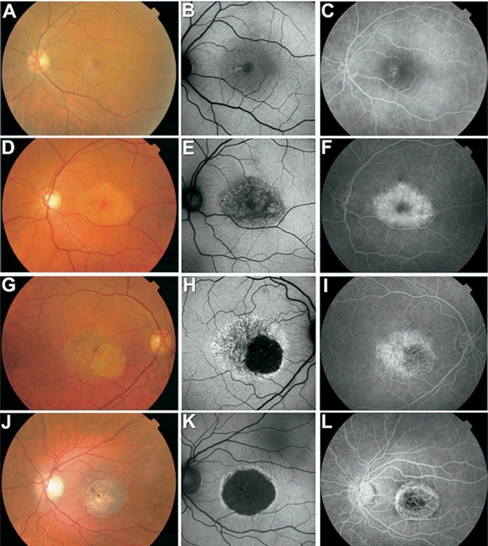 Ophthalmology-Notes - Central Areolar Choroidal Dystrophy (CACD): CACD ...