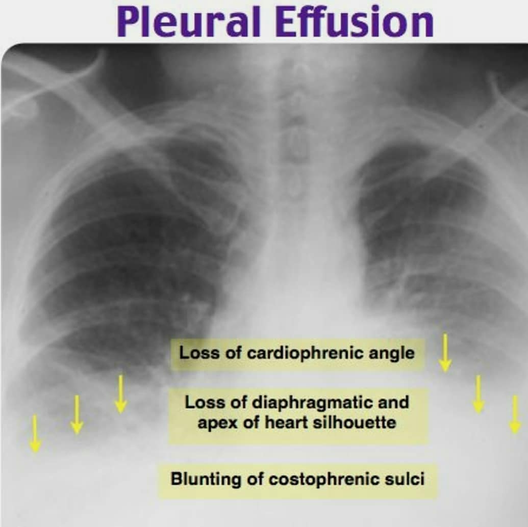 Medical - X-ray pada efusi pleura.. Untuk info dan pemesanan MMN: LINE ...