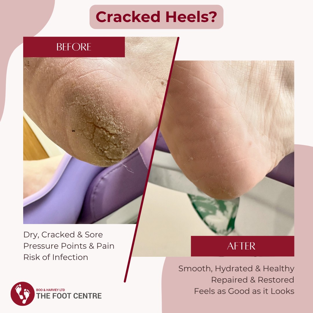 Boo & Harvey - 𝗢𝘀𝘁𝗲𝗼𝗮𝗿𝘁𝗵𝗿𝗶𝘁𝗶𝘀 Osteoarthritis is a condition that causes ...