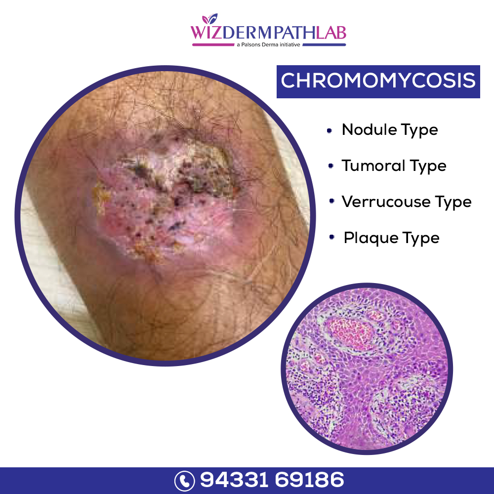 Wizderm Pathlab - Chromomycosis is a dematiaceous fungus that causes ...