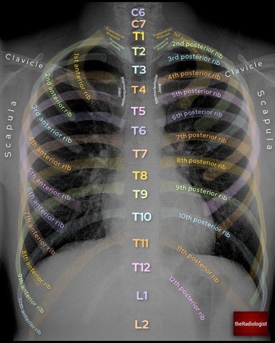 MedPic - Bone anatomy on Chest X-Ray | Facebook
