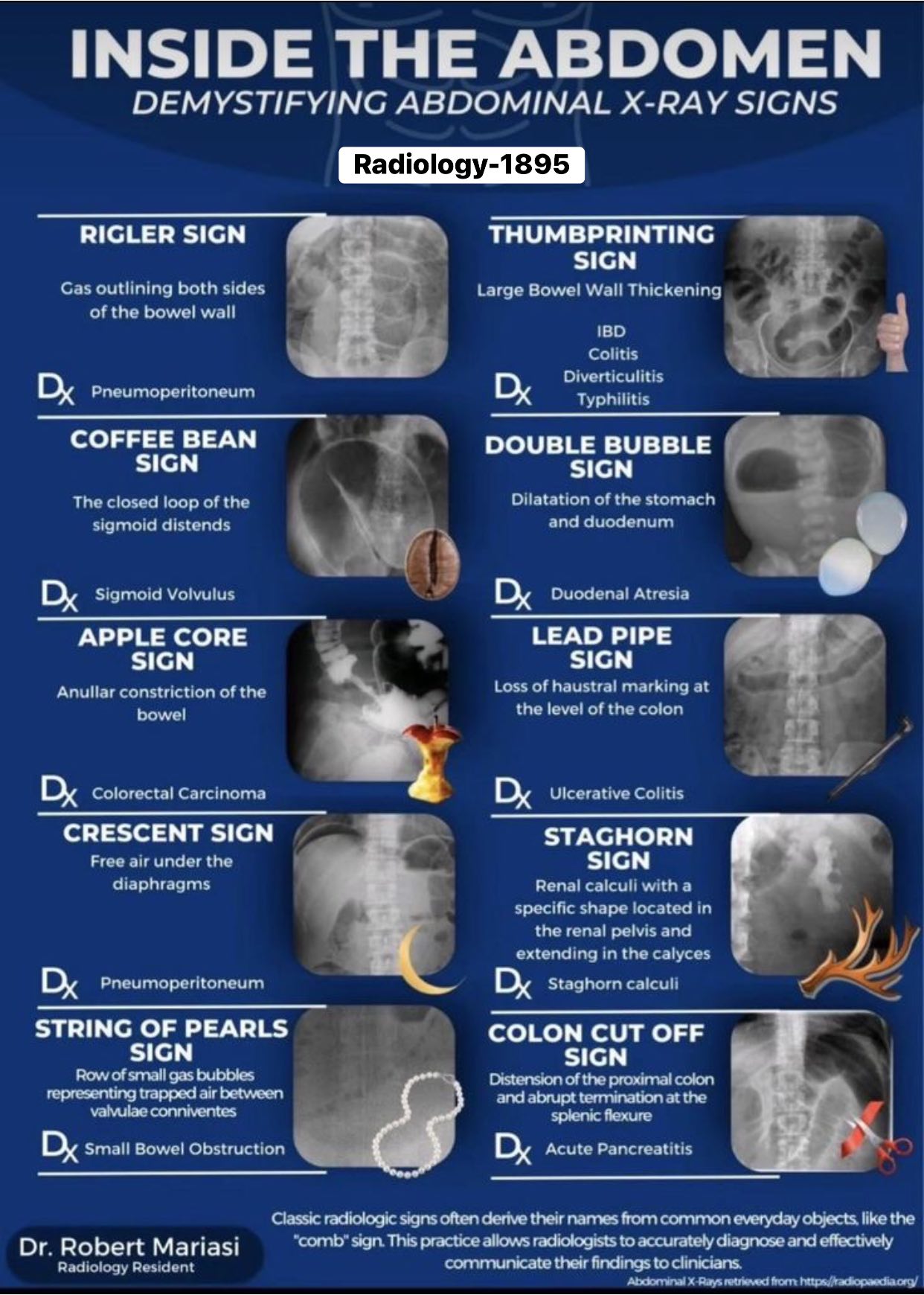 Radiology - Abdominal X-ray signs ⬇️ | Facebook