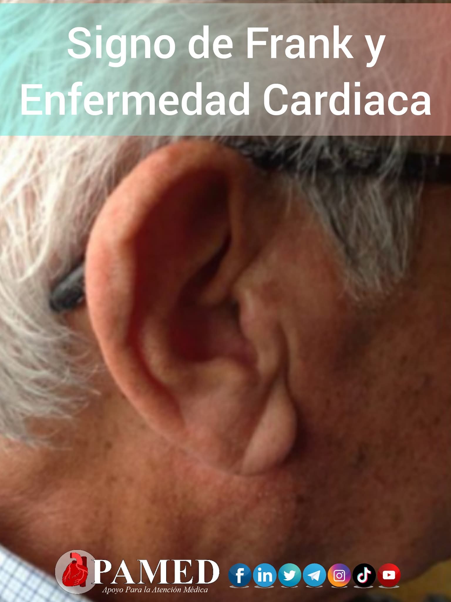 Apamed - 🫀👨🏻‍⚕️ El signo de Frank consiste en una hendidura diagonal ...