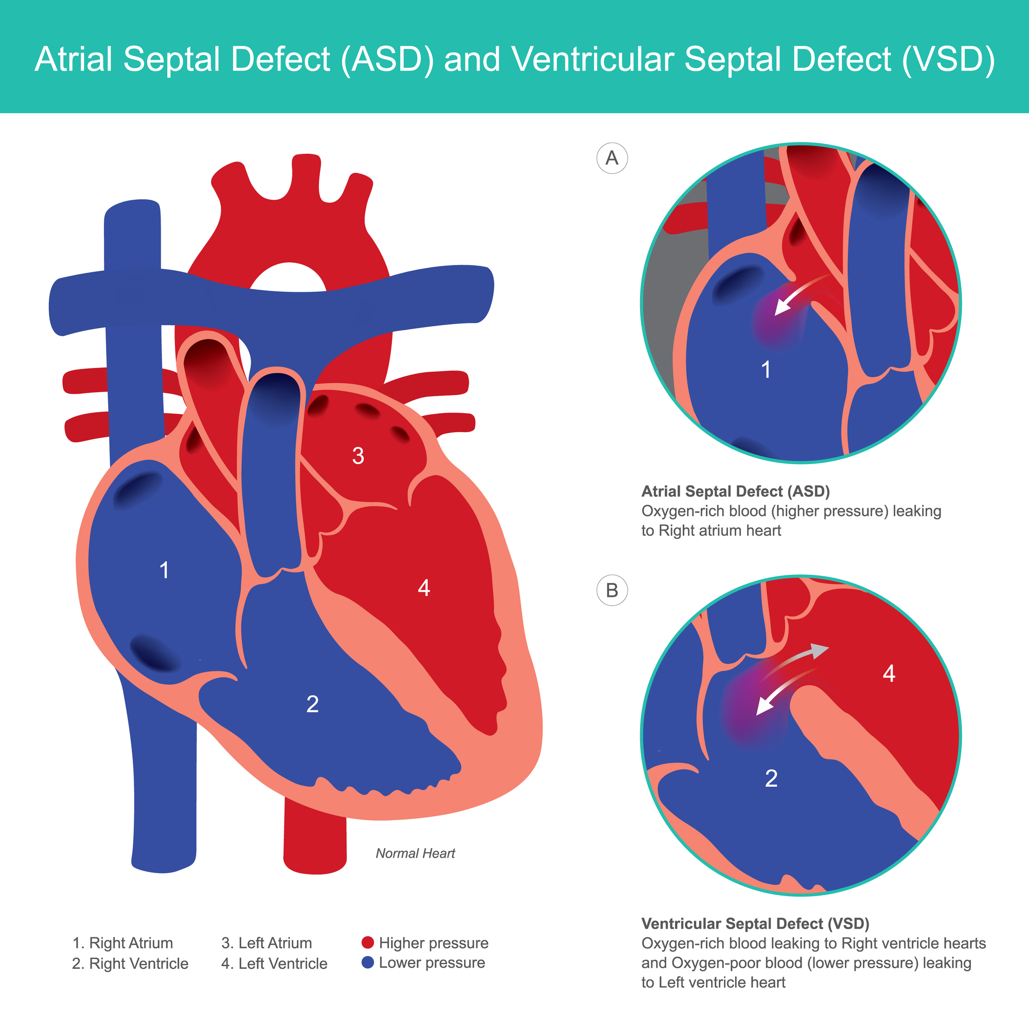 Atrial Septal Defect (ASD) and... - Respiratory Therapy Zone | Facebook