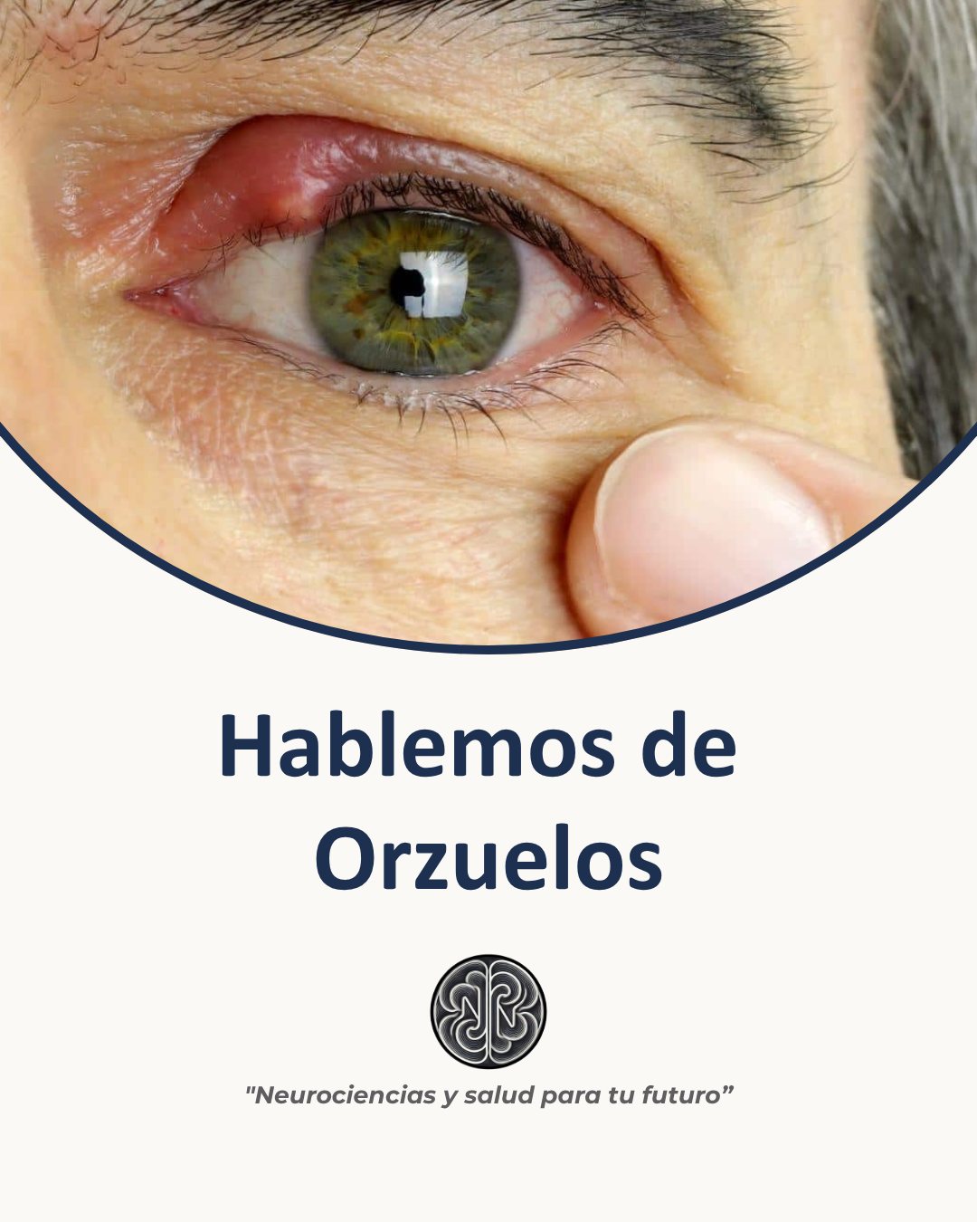 Instituto - ¿Qué son los orzuelos? Los orzuelos son una infección ...
