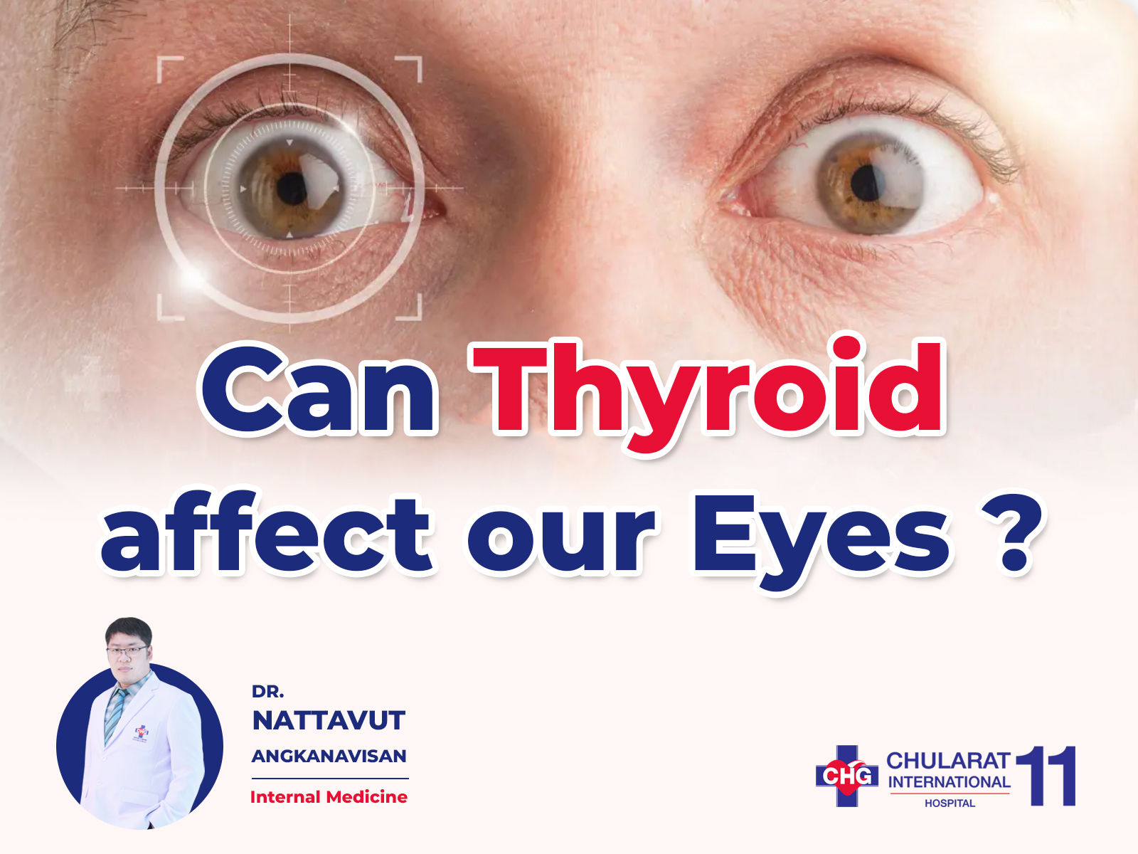 Chularat - Thyroid conditions, particularly Graves' disease, can cause ...